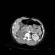 Severed kidney, kidney trauma: CT - Computed tomography